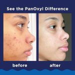 PANOXYL ACNE FOAMING WASH BENZOYL PEROXIDE 10% -156 G - Image 3