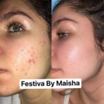 Differin Gel Acne Treatment 15g - Image 4