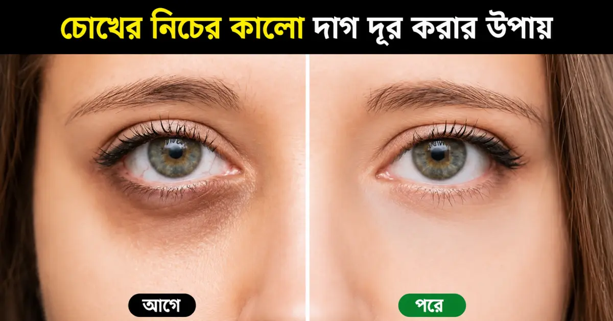 চোখের নিচের কালো দাগ দূর করার উপায়